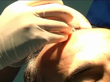 Trasplante capilar Trasplante capilar