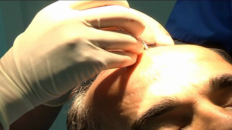 Combatir la alopecia