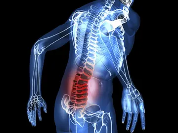 Una esperanza para los lesionados medulares Una esperanza para los lesionados medulares