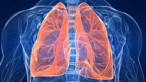 La fibrosis pulmonar La fibrosis pulmonar