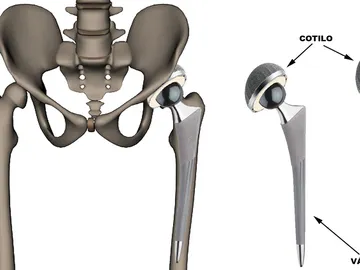 Las prótesis de cadera Las prótesis de cadera