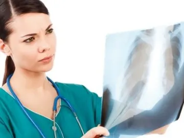 EL cáncer de pulmón EL cáncer de pulmón