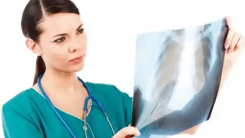 EL cáncer de pulmón EL cáncer de pulmón