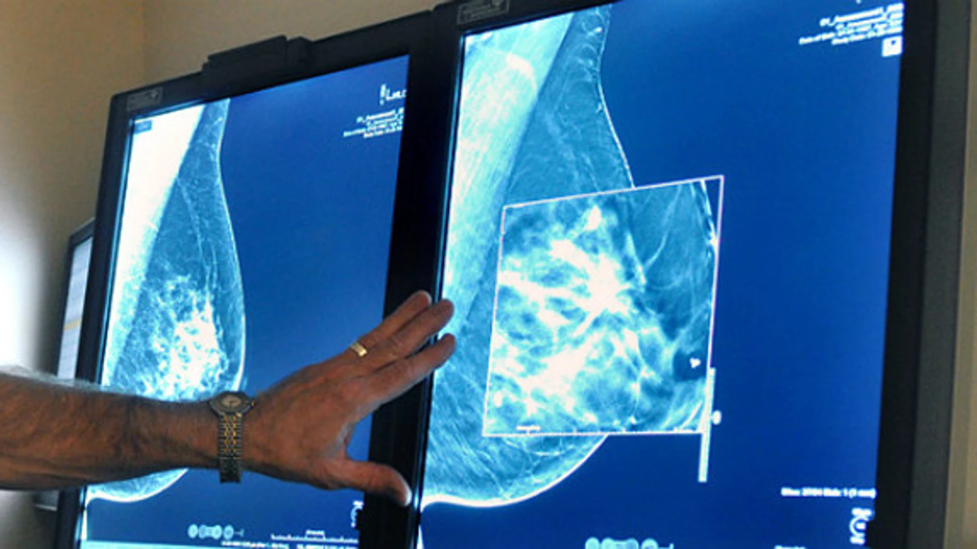 Imagen de archivo de un diagnóstico de cáncer de mama