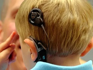 Implante coclear Implante coclear