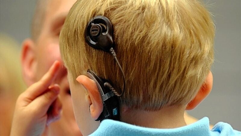 13.500 españoles pueden oír gracias al implante coclear