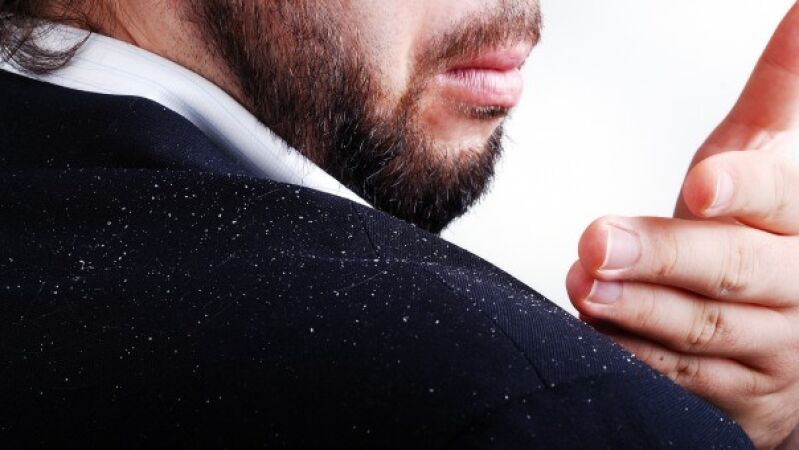 La caspa son escamas de piel que pueden obstruir los folículos y dañar la salud del cabello