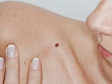 Si alguien te importa, revisa sus lunares Si alguien te importa, revisa sus lunares