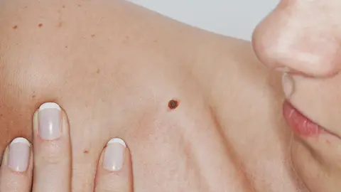 Si alguien te importa, revisa sus lunares Si alguien te importa, revisa sus lunares