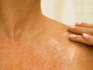 La lucha contra el cáncer de piel La lucha contra el cáncer de piel