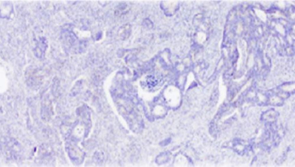 Cáncer de colon