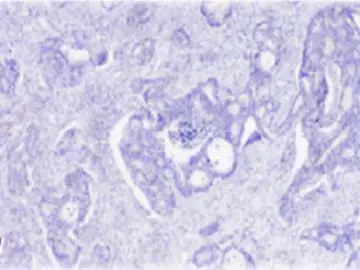 Cáncer de colon Cáncer de colon