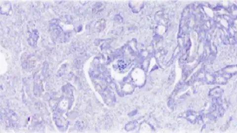 Cáncer de colon Cáncer de colon